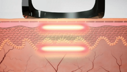 TRI-BEAM